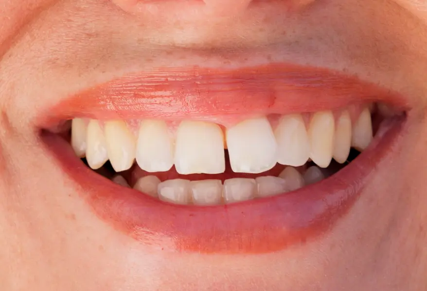 Imagen de sonrisa antes del tratamiento de ortodoncia